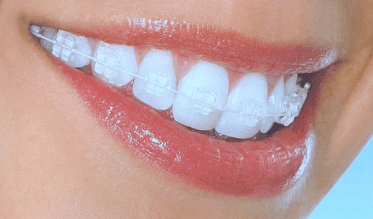 Close-up of teeth braces