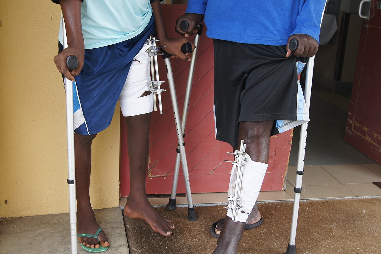 External fixator on a patient
