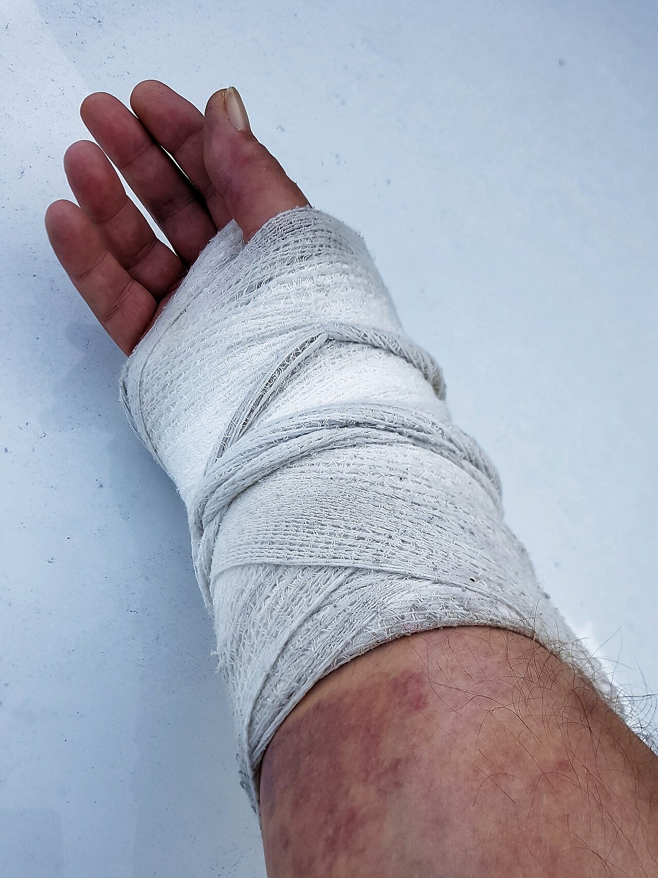 Orthopedic plaster cast